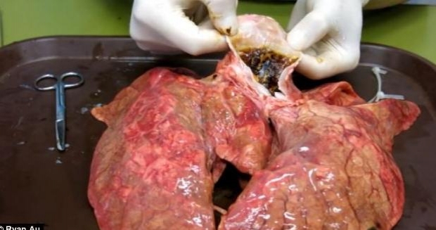 (në foto mushkëria e dëmtuar nga duhani)