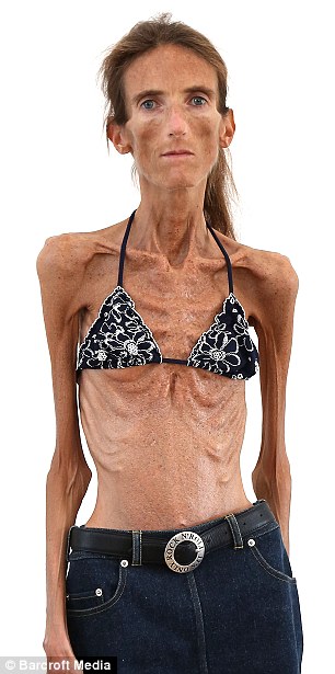 Valeria Levitin anoreksi 